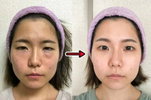 【ガチレポ】TCB東京中央美容外科のクマ取り手術！老け顔からの卒業